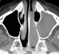 polype antrochoanal (Killian)