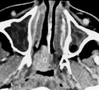 fibrome nasopharyngien