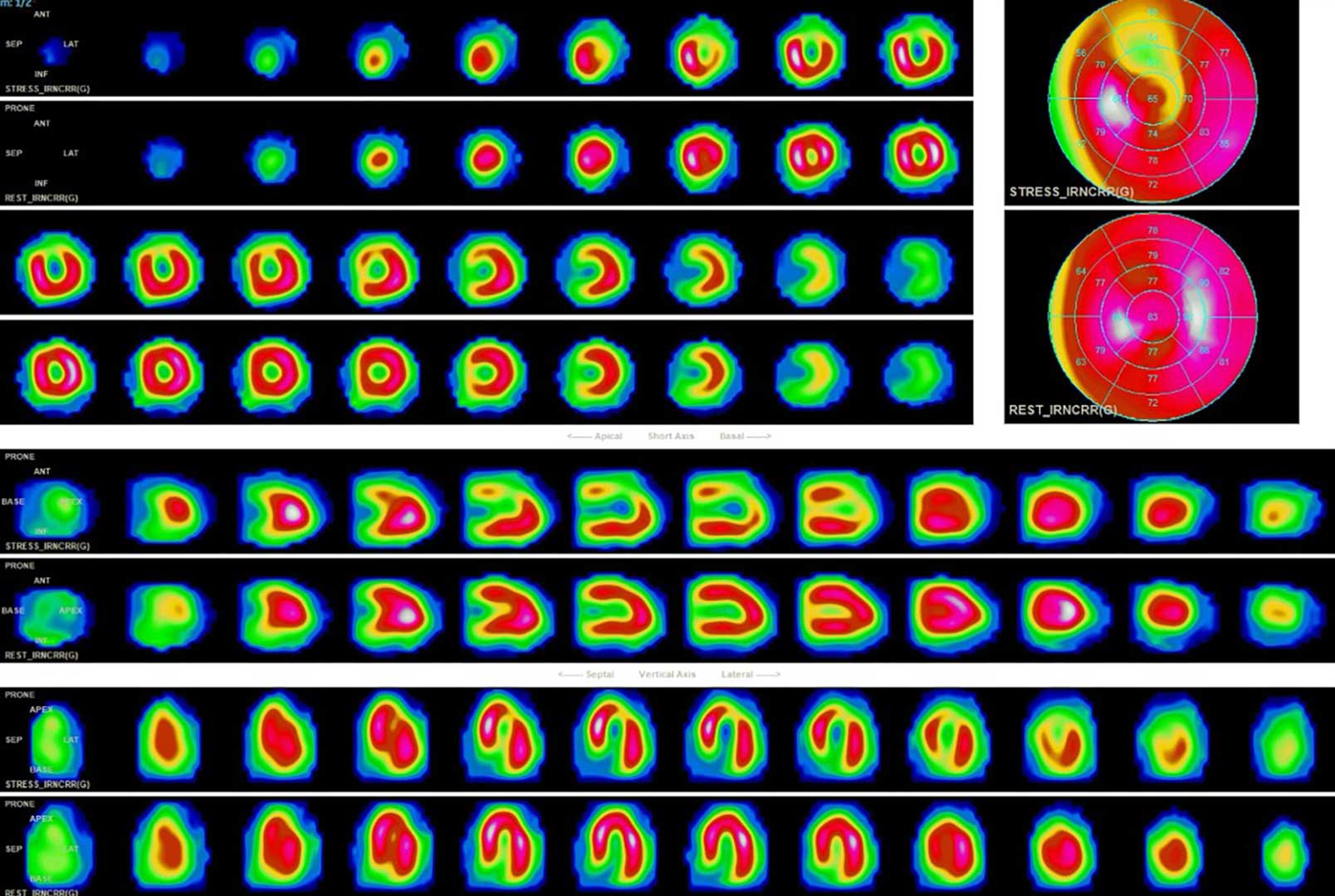 Scintigraphie myocardique