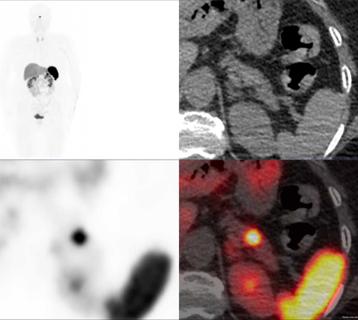 TEP aux analogues de la somatostatine