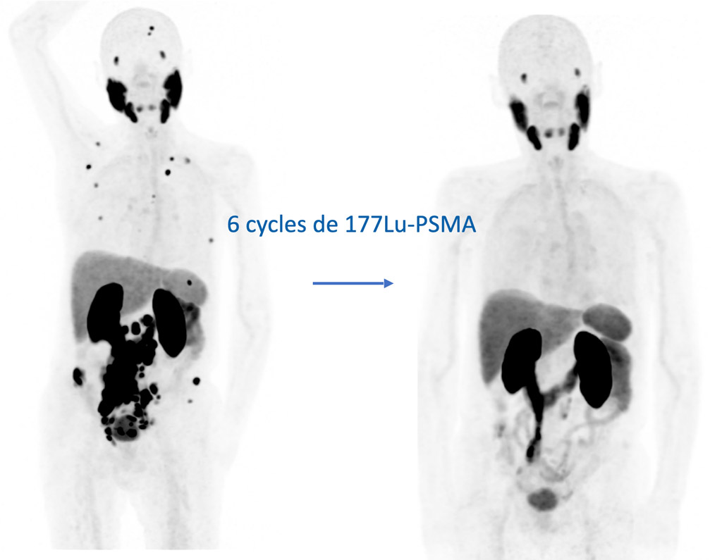 Exemple de traitement par 177Lu-PSMA