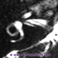 IRM: oreille interne