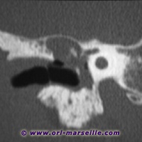 TDM incidence coronale