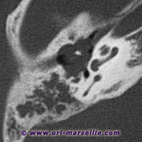 TDM incidence axiale