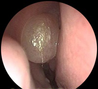 Polypose nasosinusienne