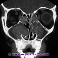 TDM: Polypose nasosinusienne