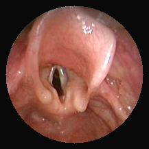 larynx d'un enfant
