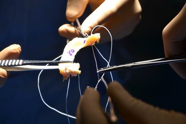 Préparation du greffon avec lassage des racines méniscales antérieure et postérieures pour permettre leur fixation osseuse.