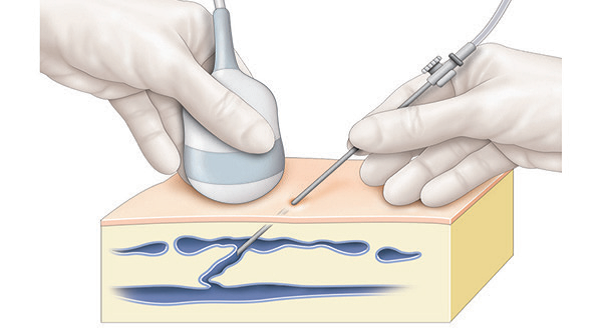 Occlusion de veines par radiofréquence. Illustration Cyrille MARTINET