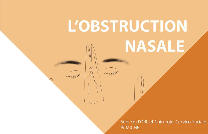 fiche pathologie du service ORL et chirurgie cervico-faciale de l'Hôpital de la Conception de Marseille