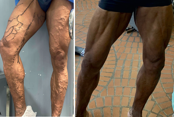 Varices bilatérales avant et après traitement mini-invasif