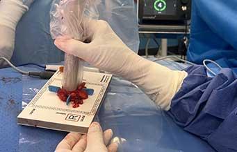 2025-10-15-card-clip-magnetique-reperage-lesions-non-palpables-sein-avant-operation.jpg