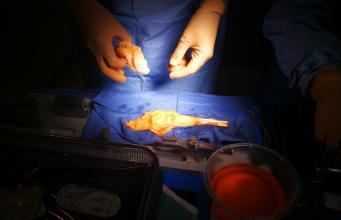 (Allo) Greffes des ligaments du genou