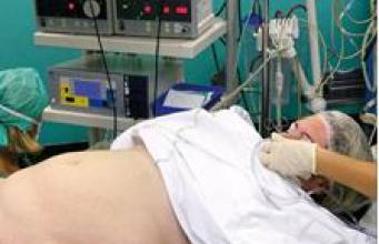 Chirurgie de l’obésité, 200ème Sleeve gastrectomie réalisée à l’hôpital de la Timone