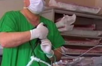 Asthme sévère : l'espoir de la thermoplastie