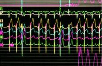 Cardiologie : une nouvelle technique pour prévenir les AVC
