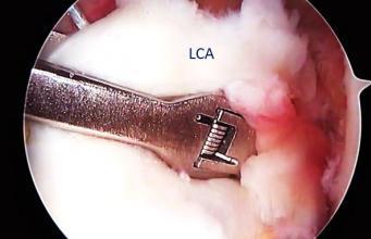 Réparer ou remplacer les ligaments croisés ?