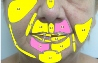 Utilité du lipofilling contre le handicap du visage des patientes atteintes de sclérodermie
