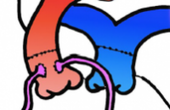 Imagerie des cardiopathies congénitales
