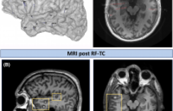 Effet de la thermocoagulation sur l'activité et la connectivité cérébrale de patients épileptiques pharmaco-résistants