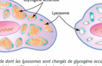 Cohorte française de patients atteints de la forme infantile classique de la maladie de Pompe : suivi à long terme de 64 enfants 