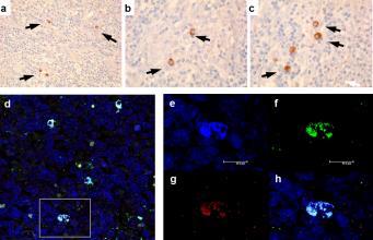 Marseillevirus, un virus géant associé au cancer des ganglions